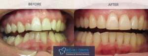 Invisalign