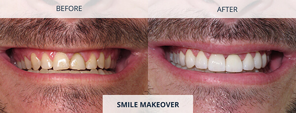 Smile-Makeover