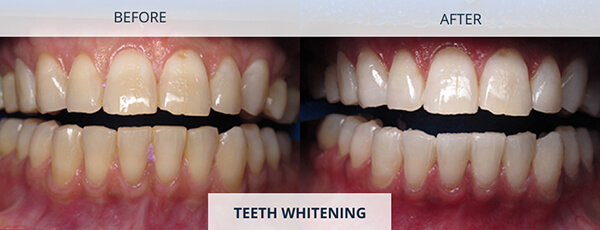 Teeth-Whitening