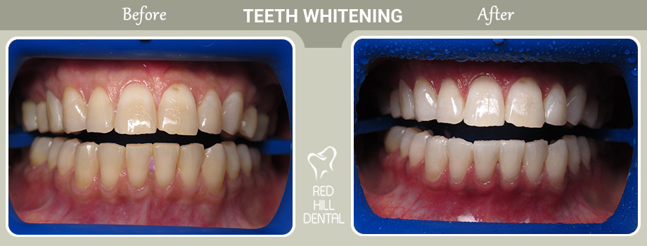 Teeth Whitening case John