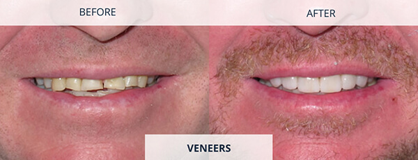 Veneers