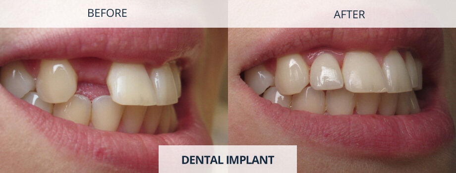 Implants