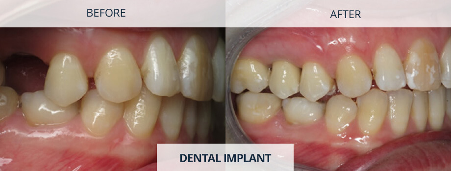 Dental implants