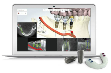 Illustration of digital dental implants on laptop