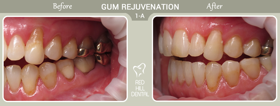 gum rejuvenation case 1a