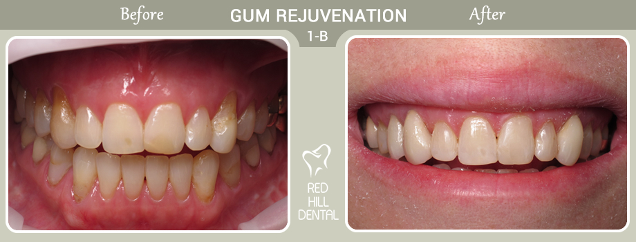 gum rejuvenation case 1b