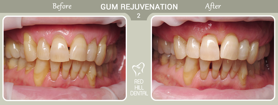 gum rejuvenation case 2