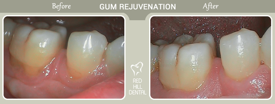gum rejuvenation case Gail