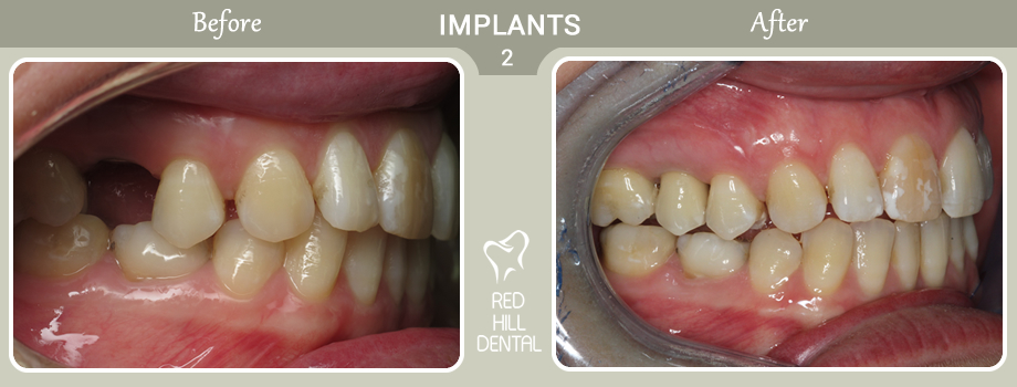 implants case 2