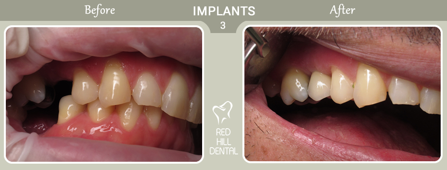 implants case 3