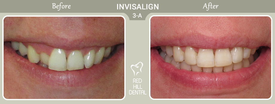 Invisalign case 3a