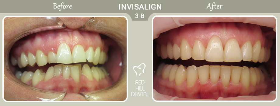 Invisalign case 3b