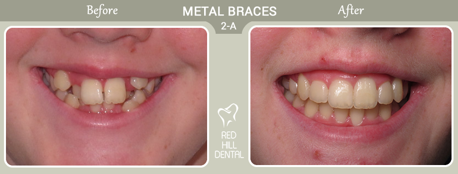 metal braces case 2a