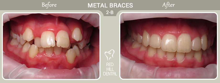metal braces case 2b