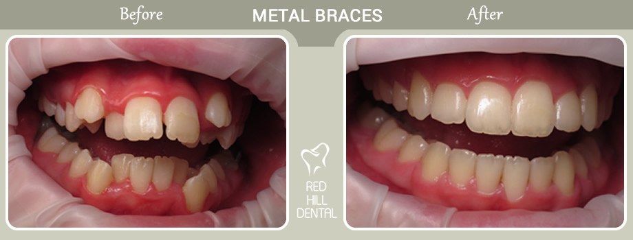 metal braces case Kathryn 1