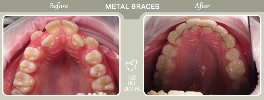 metal braces case Kathryn 2