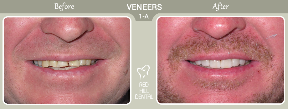 veneers case 1a