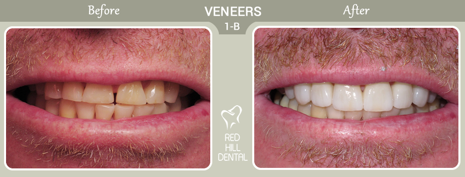  veneers case 1b