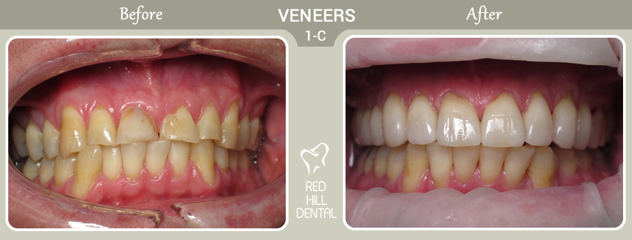  veneers case 1c