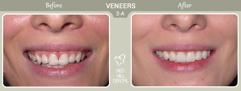  veneers case 2a