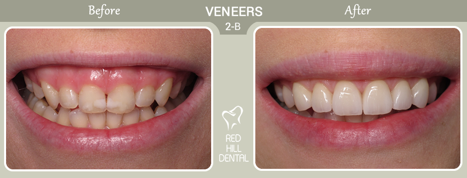  veneers case 2b