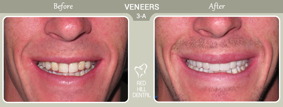  veneers case 3a