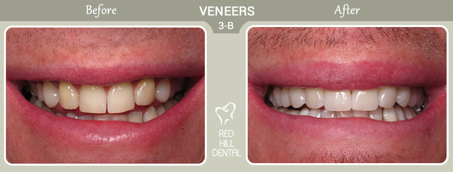 veneers case 3b