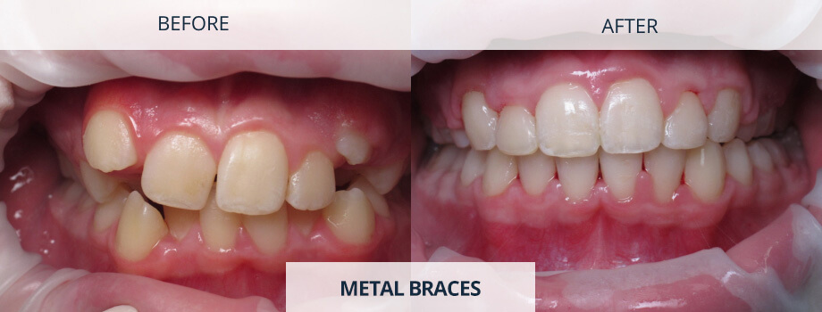 Metal-Braces