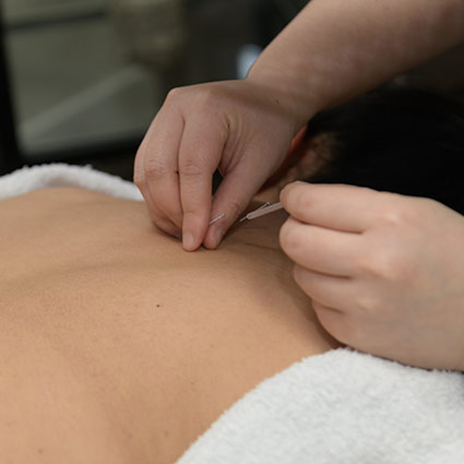 patient getting acupuncture