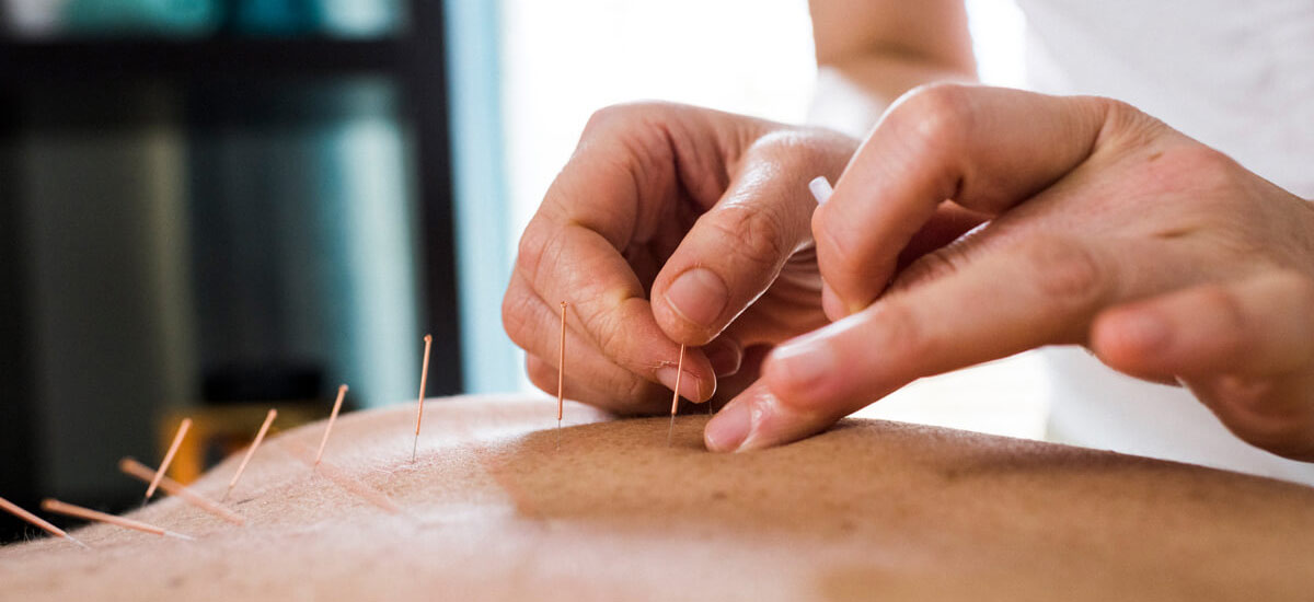 acupuncture needles in back