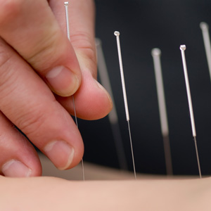 close up of cupuncture needles on patient