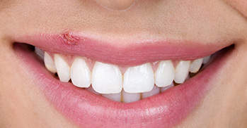 woman with coldsore on lip