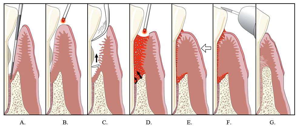 Lanap procedure steps