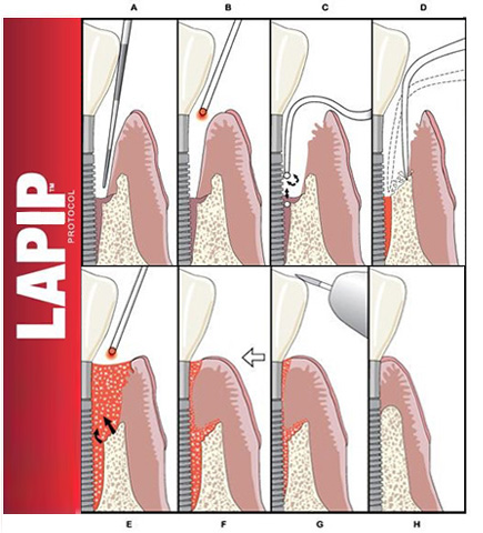 lapip process