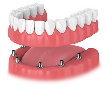Implant denture Wilton