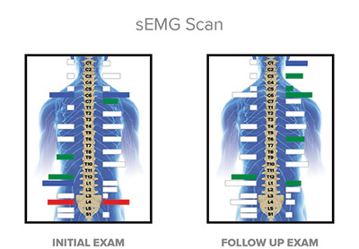 sEMG scan graphic