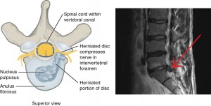 sciatic nerve pain