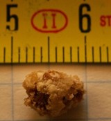 kidney stone symptoms