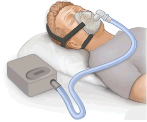 new device for sleep apnea