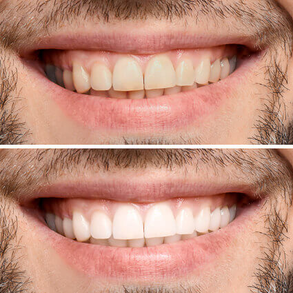 Before-and-after-teeth-whitening