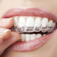 dentist-ferntree-gully-invisalign