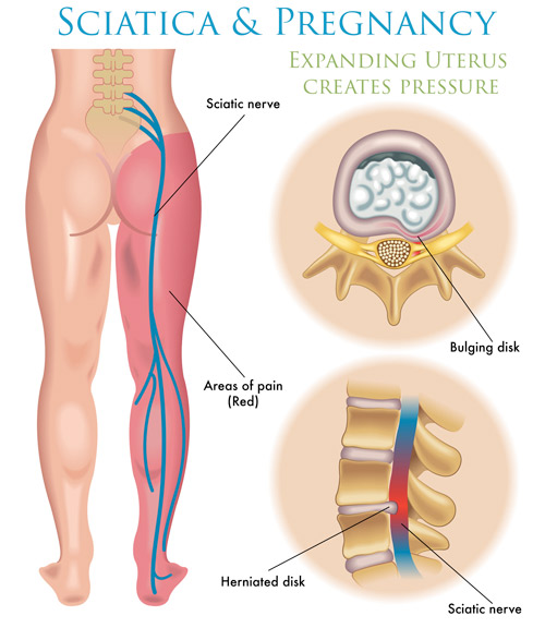 Diagram of sciatica