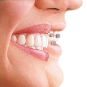 Invisalign clear aligners 