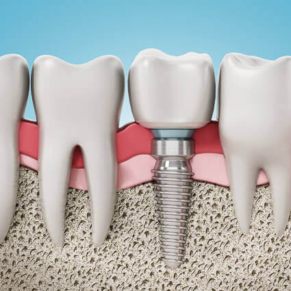 realistic-cross-section-with-dental-implant-sq