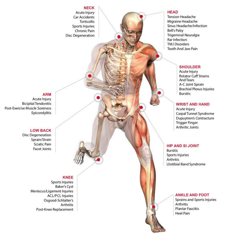 Diagram of laser therapy sites