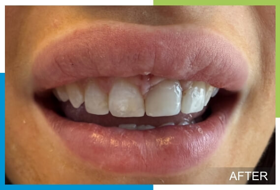 Cosmetic-Bonding-After
