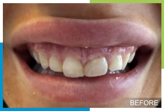 Cosmetic-Bonding-After