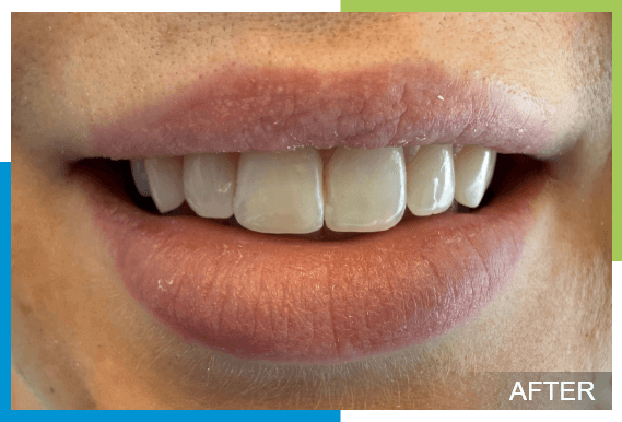 Cosmetic-Bonding-After