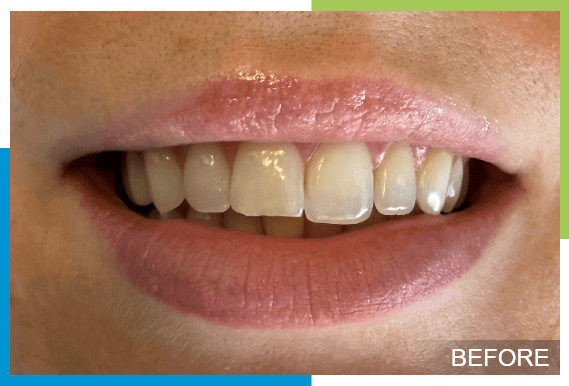 Cosmetic-Bonding-Before