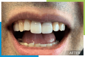 Smile-Makeovers-After